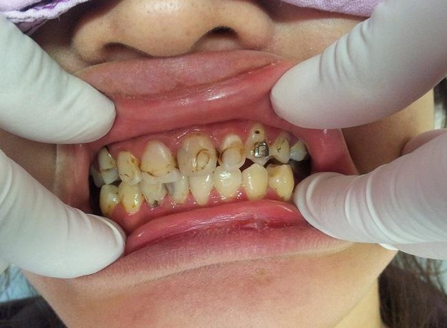 อันตราย! ดัดฟันเถื่อน ติดเชื้อในกระแสเลือดถึงตายได้ - Chiang Mai News