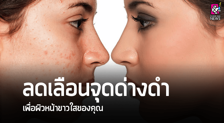 ลดเลือนจุดด่างดำ เพื่อผิวหน้าขาวใสของคุณ - Chiang Mai News