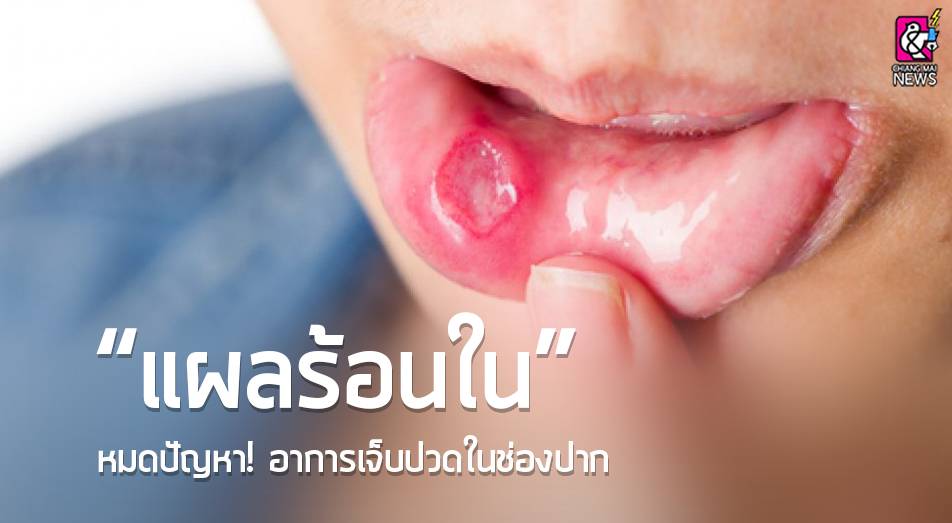 แผลร้อนใน” หมดปัญหา! อาการเจ็บปวดในช่องปาก - Chiang Mai News